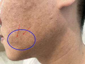 Melano CC 維他命C亮白精華實測_痘疤_找Cha研究室