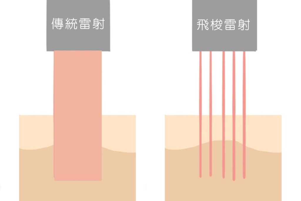 醫美雷射