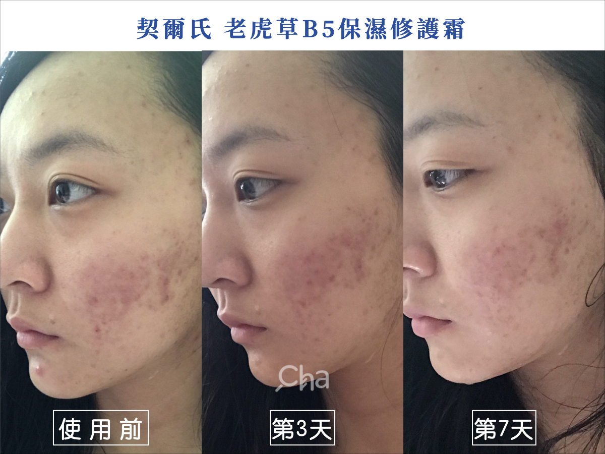 14天淡化痘疤挑戰 開架vs專櫃 積雪草保養 到底誰比較有效 找cha研究室