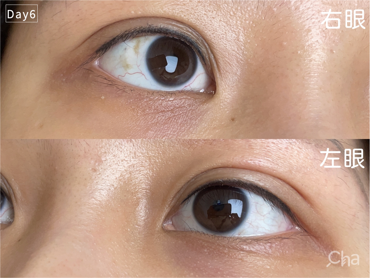 美瞳線, 美瞳線 效果, 美瞳線 後遺症,美瞳線 會痛嗎, 美瞳線 術後, 隱形眼線, 紋眼線, 繡眼線, 妝感眼線