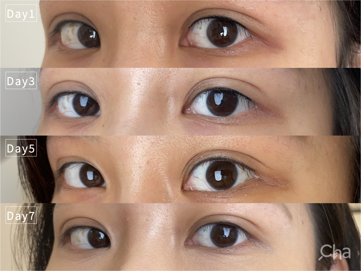 美瞳線, 美瞳線 效果, 美瞳線 後遺症,美瞳線 會痛嗎, 美瞳線 術後, 隱形眼線, 紋眼線, 繡眼線, 妝感眼線