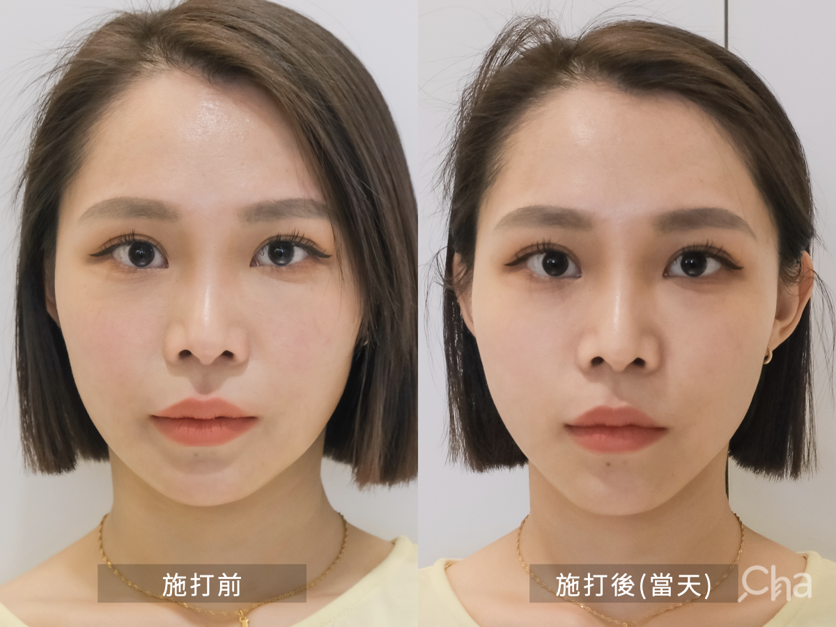 過來人的醫美下半臉拉提分享：挑戰海芙音波不上麻藥直接打！+術後1.5個月效果全記錄– 找Cha研究室