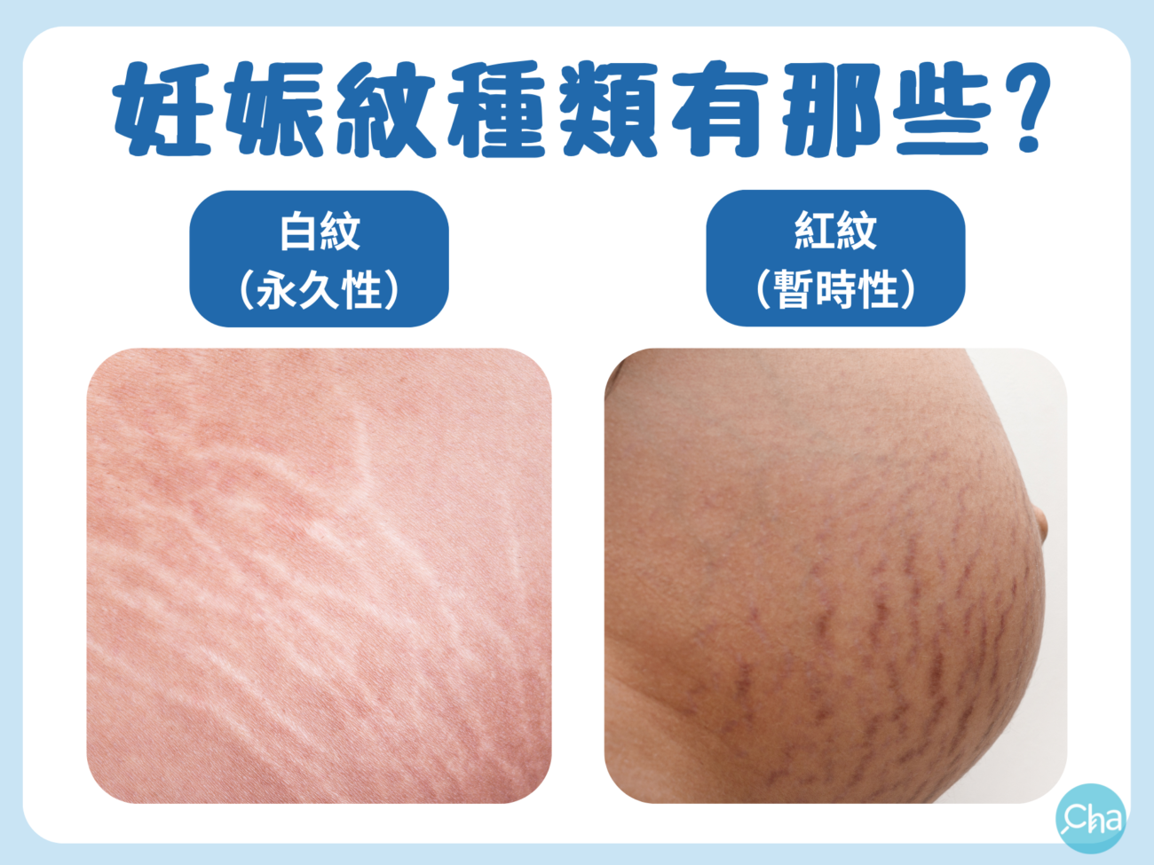 妊娠紋不是產後宿命！媽媽社團狂推妊娠霜Top5，掌握按摩手法有效擊退紋路上身！ – 找Cha研究室