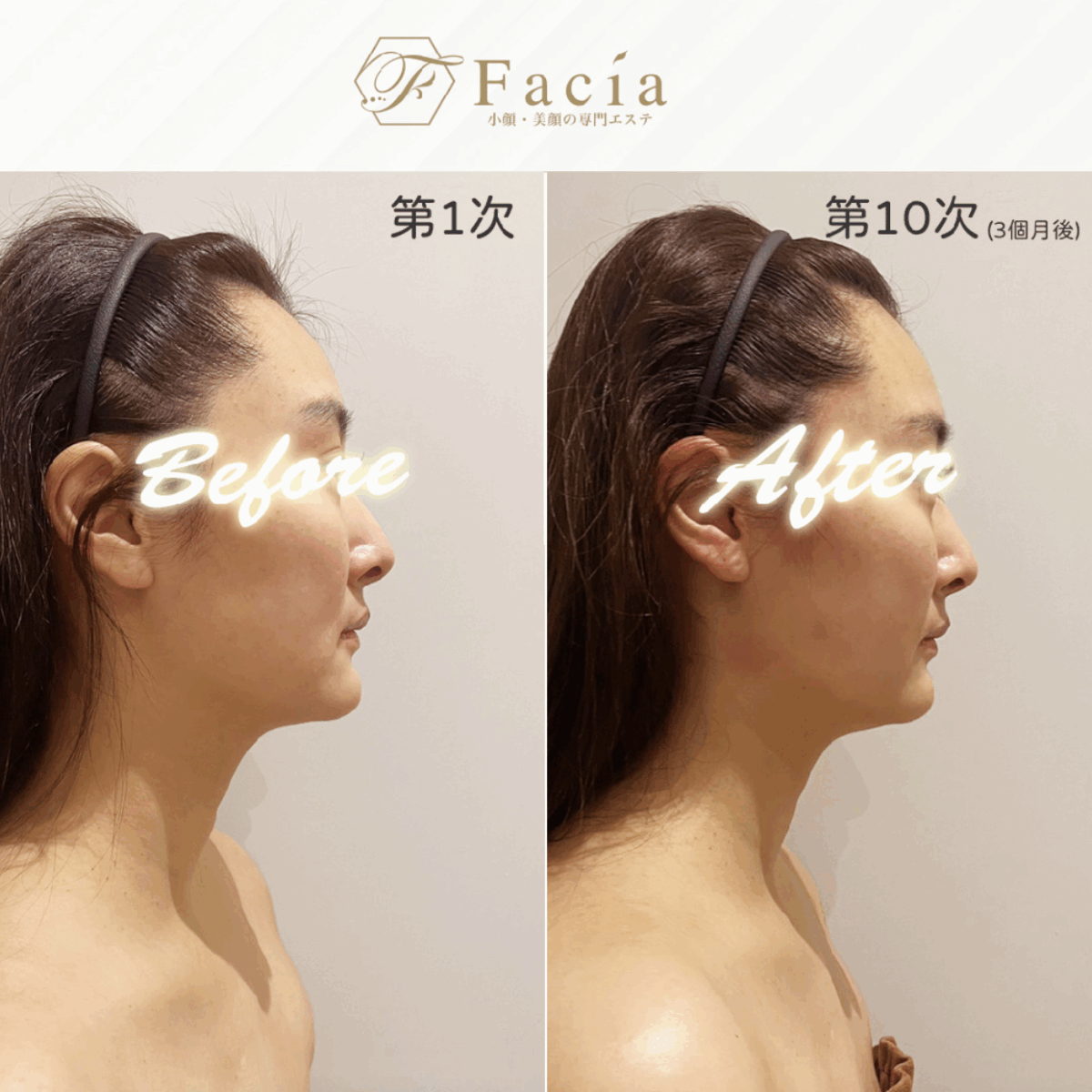 Facia小臉按摩課程 前後對比